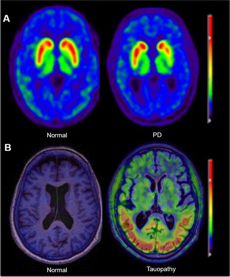 spect scan brain for parkinson's disease